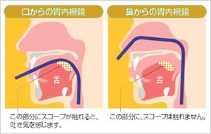 苦痛、吐き気の少ない胃カメラ検査は、鼻から（経鼻）です。